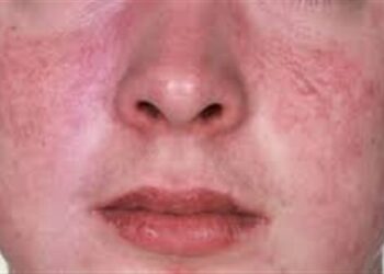 أعراض الذئبة الحمراء.. ونصائح تساعد على تجنب نوباتها