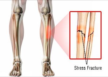 كسر الاجهاد ! ما هي؟ و الأعراض وطرق الوقاية؟