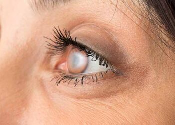 ما هو إعتام عدسة العين وكيفية علاجه؟