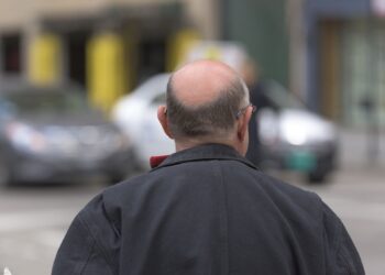 منوعات.. العلماء يقتربون من ابتكار تقنية تعالج الصلع