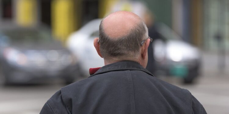 منوعات.. العلماء يقتربون من ابتكار تقنية تعالج الصلع