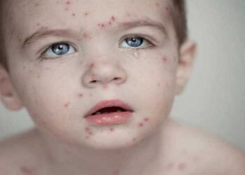 الصحة العالمية تحذر.. الحصبة تعود بقوة لأوروبا!