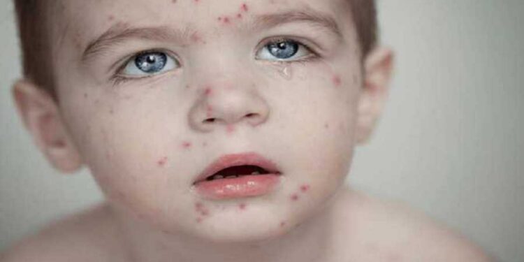 الصحة العالمية تحذر.. الحصبة تعود بقوة لأوروبا!