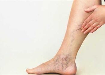 طبيبٌ يحذّر من خطورة تمدد الأوعية الدموية