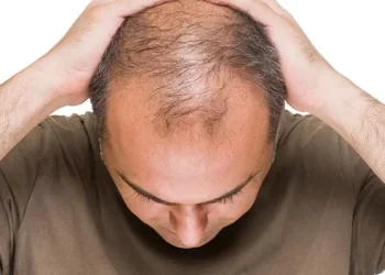 خبراء يحددون أسباب الصلع بين الرجال