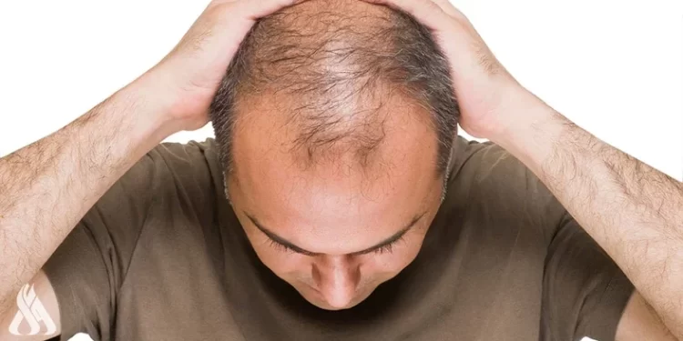 خبراء يحددون أسباب الصلع بين الرجال