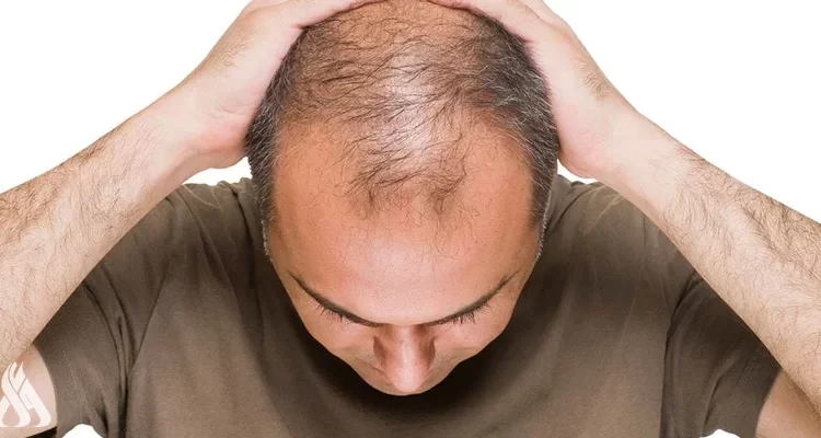 خبراء يحددون أسباب الصلع بين الرجال