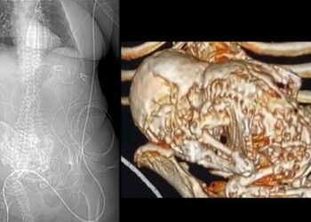 وفاة امرأة بعد أكتشاف حملها بـطفل متحجر لأكثر من 50 عاما