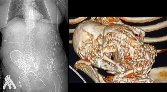 وفاة امرأة بعد أكتشاف حملها بـطفل متحجر لأكثر من 50 عاما