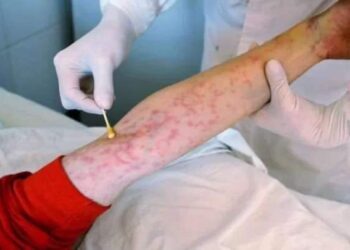 وضع مقلق وخطير.. ارتفاع أعداد المصابين بمرض الإيدز في لبنان!