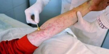 وضع مقلق وخطير.. ارتفاع أعداد المصابين بمرض الإيدز في لبنان!