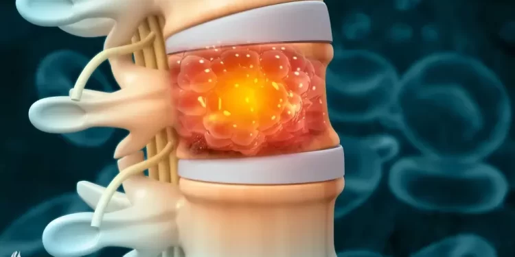 خبراء يكشفون عن عارض شائع لسرطان العظام لا ينبغي تجاهله أبدا
