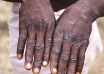 أوغندا تسجل إصابتين جديدتين بجدري القردة