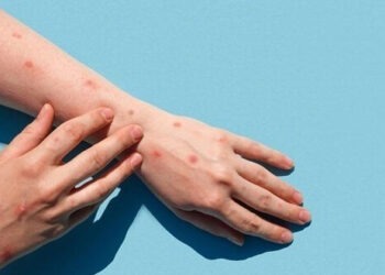 تايلاند: تسجيل إصابة بجدري القردة