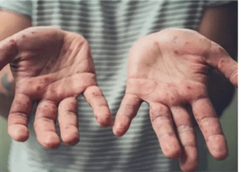 الوفيات تزداد ومخاوف من جائحة.. كيف تواجه مصر جدري القرود؟