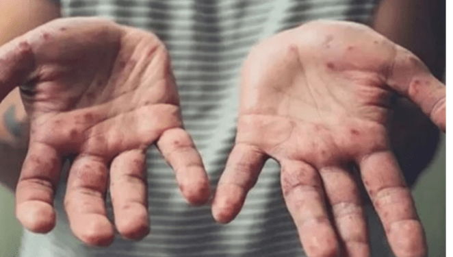 الوفيات تزداد ومخاوف من جائحة.. كيف تواجه مصر جدري القرود؟