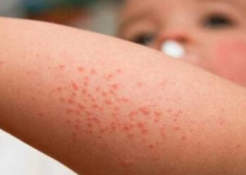 حمى غرب النيل… الأعراض وطرق الوقاية