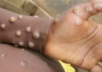 اجتماع طارئ للصحة العالمية بسبب زيادة الإصابات بجدري القردة