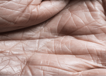 نمط غريب على الجلد قد يكون علامة تحذيرية لمرض مميت