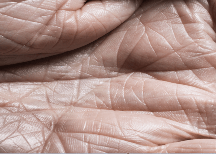 نمط غريب على الجلد قد يكون علامة تحذيرية لمرض مميت