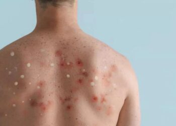 خبراء يكشفون عن افضل طرق الحماية من جدري القردة