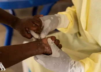 أوغندا ترصد إصابتين جديدتين بجدري القردة