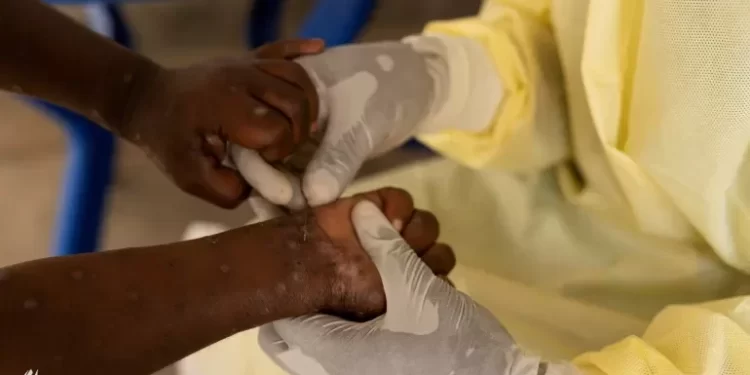 أوغندا ترصد إصابتين جديدتين بجدري القردة