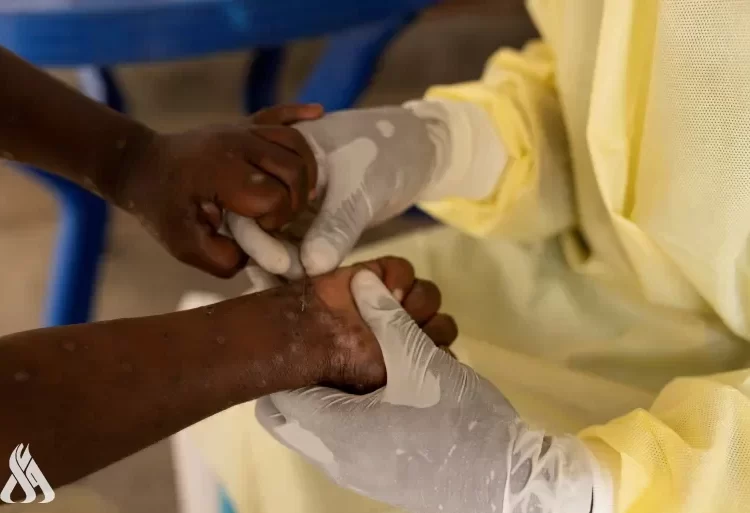 أوغندا ترصد إصابتين جديدتين بجدري القردة