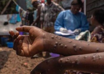 مراكز مكافحة الأمراض: فيروس جدري القردة أصبح خارج السيطرة في أفريقيا