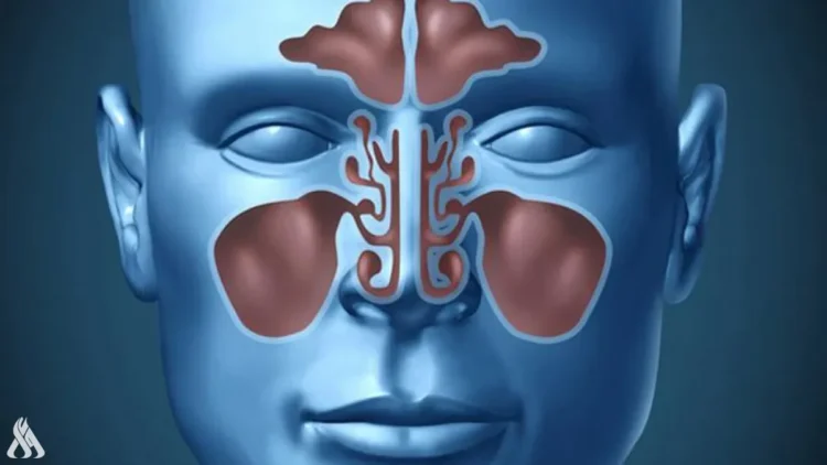 اخصائي يكتشف طريقة لعلاج التهاب الجيوب الأنفية