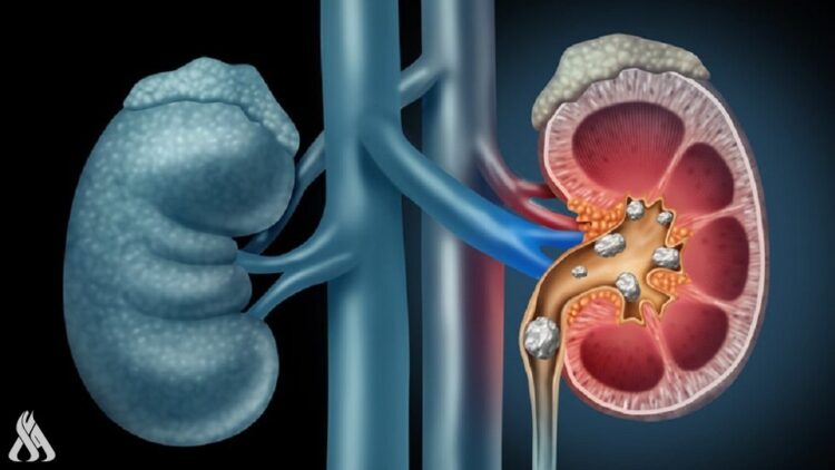 أخصائي يوضح الأطعمة الضارة بالكلى