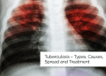 صيدلية حرمون: مرض السل – أنواعه وأسبابه وانتشاره وعلاجه