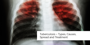 مرض السل – أنواعه وأسبابه وانتشاره وعلاجه