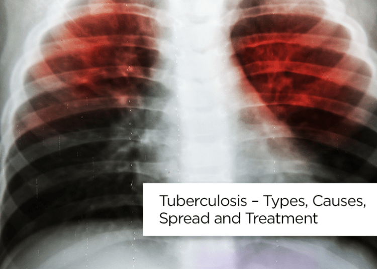 صيدلية حرمون: مرض السل – أنواعه وأسبابه وانتشاره وعلاجه