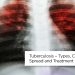 مرض السل – أنواعه وأسبابه وانتشاره وعلاجه