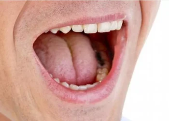 ما أسباب جفاف الفم اثناء الليل وكيف يمكن علاجه؟