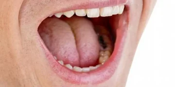 ما أسباب جفاف الفم اثناء الليل وكيف يمكن علاجه؟