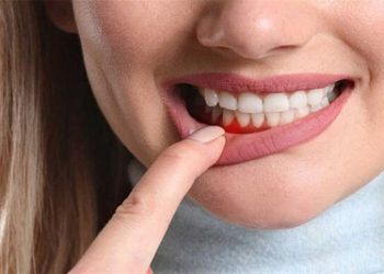 تعرفوا الى أعشاب لعلاج التهاب اللثة