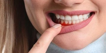 تعرفوا الى أعشاب لعلاج التهاب اللثة