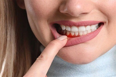 تعرفوا الى أعشاب لعلاج التهاب اللثة