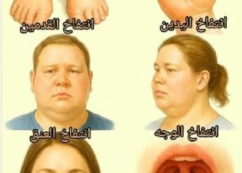 نصائح للتعامل مع التورم