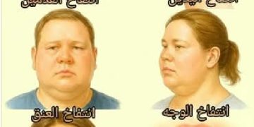 نصائح للتعامل مع التورم