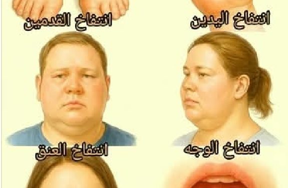 نصائح للتعامل مع التورم