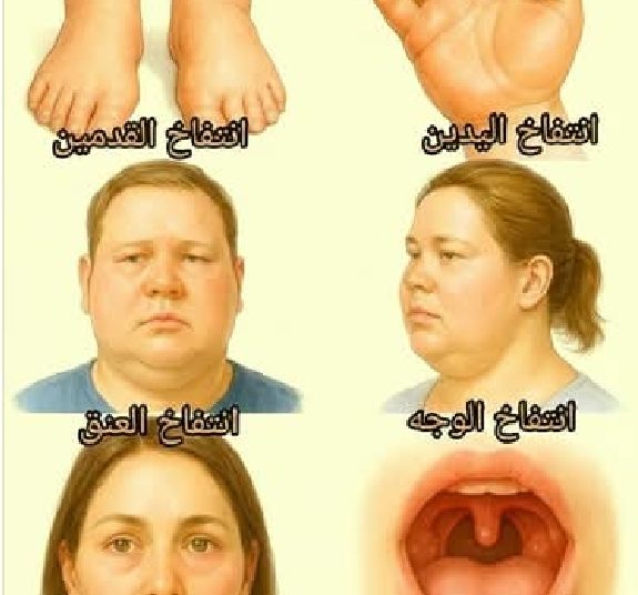 صيدلية حرمون: نصائح للتعامل مع التورم